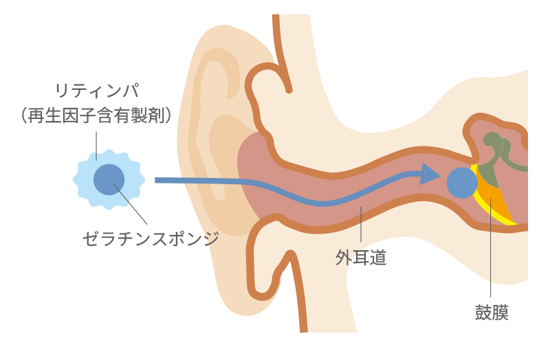 鼓膜穿孔の説明イラスト